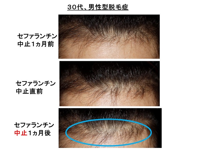 円形脱毛症　病院